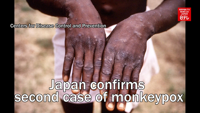 Japan confirms second case of monkeypox