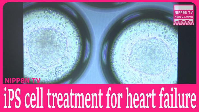 World's first iPS cell regenerative treatment for heart failure tested in Japan