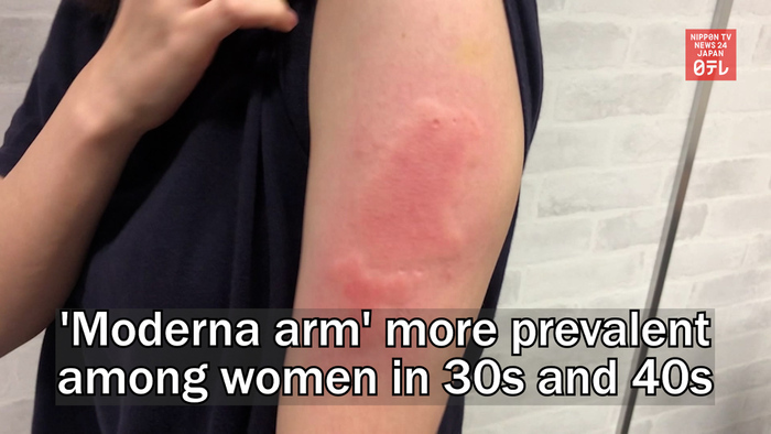 Moderna arm more prevalent among women in 30s and 40s