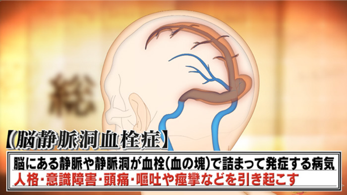 いつも悲しくて涙が止まらない 深刻な症状の原因は意外にも 鼻のすすりすぎ The突破ファイル 日本テレビ